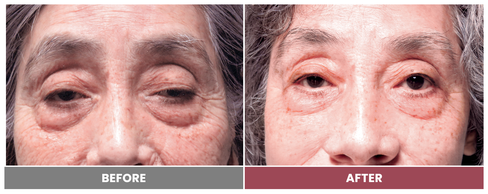 PTOSIS REPAIR - Case 11
